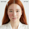 LumiClear Acne Light Therapy Pen